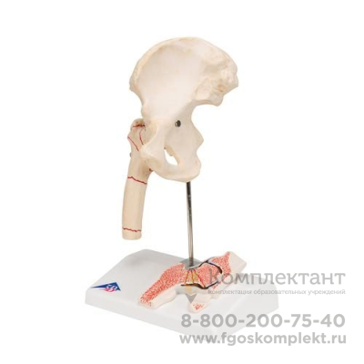 Модель перелома бедренной кости и остеоартрита тазобедренного сустава - 3B Smart Anatomy